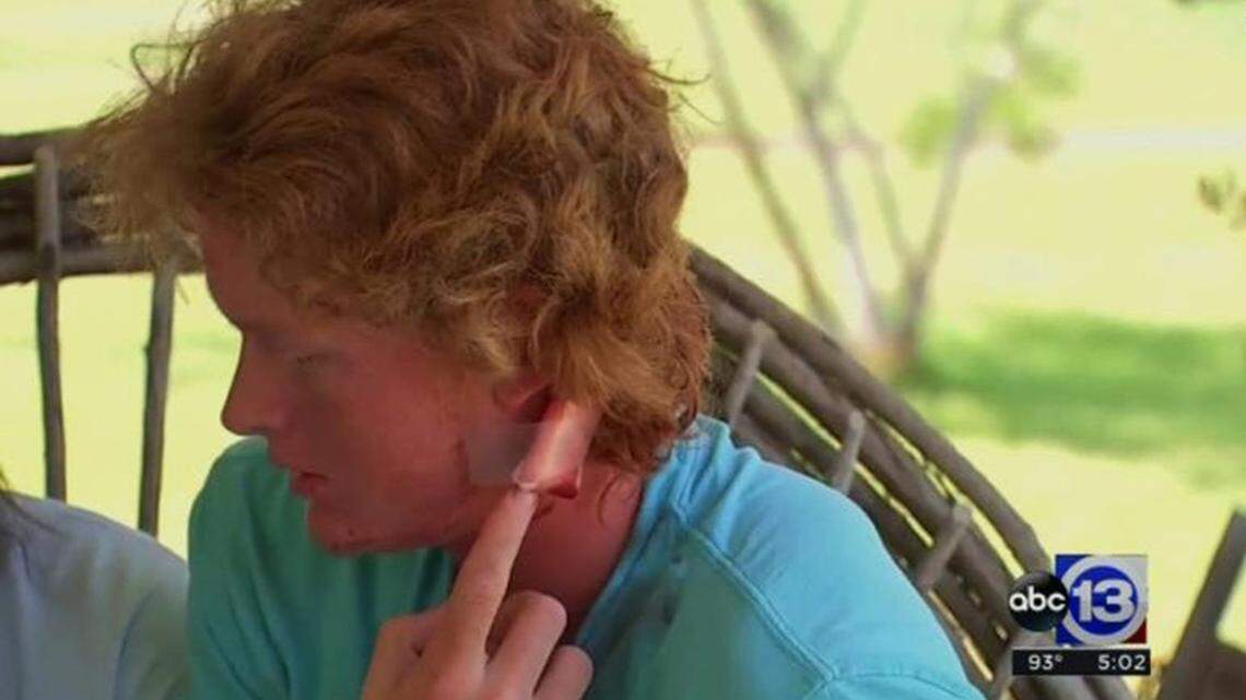 Rome Shubert, 16, points to the exit wound from the bullet that struck him in the head during Friday's mass shooting at Santa Fe High School in southeast Texas.