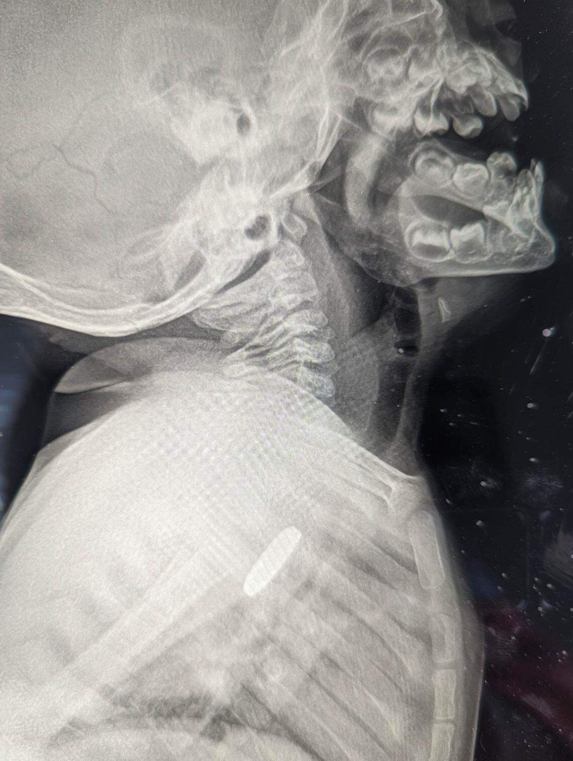 The surgeon said the battery was so stuck to Luke’s esophagus that the surgery to remove it might be fatal.