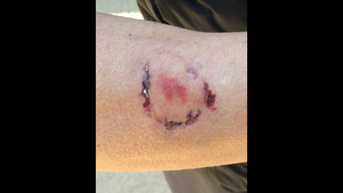 Police said the dog owner left “significant wounds” on the jogger’s forearm, which clearly were not bite marks left by a dog.