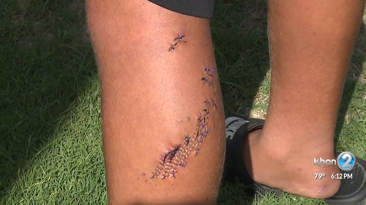 A 14-year-old had to get more than 100 stitches after a shark bit his leg.