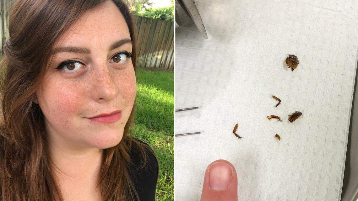 Katie Holley, 29, of Melbourne, Fla., and six parts of the roach that took up residence inside her right ear for nine days.