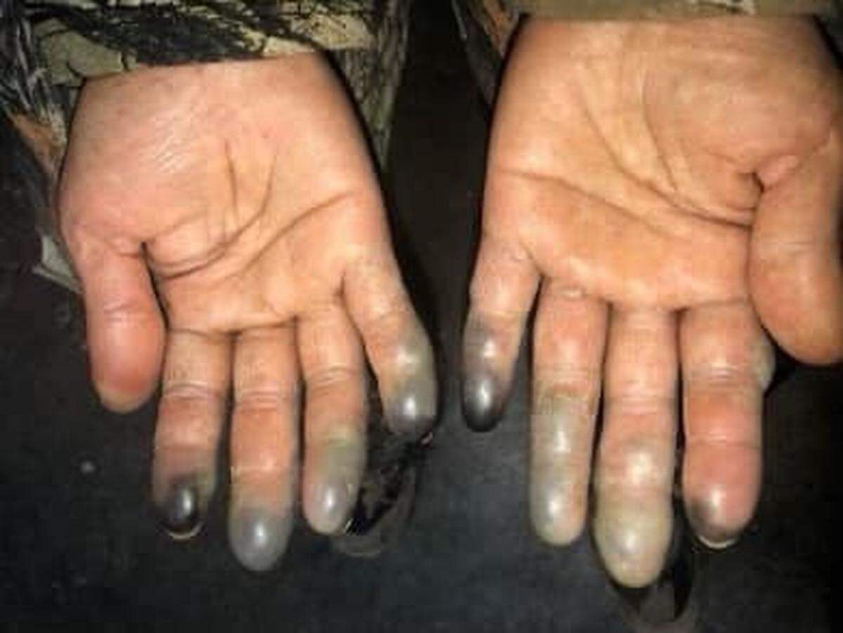 This is what severe frostbite can do to fingers exposed too long to cold temperatures, experts say. Charlotte’s snow storm will be accompanied by dangerously cold temperatures.