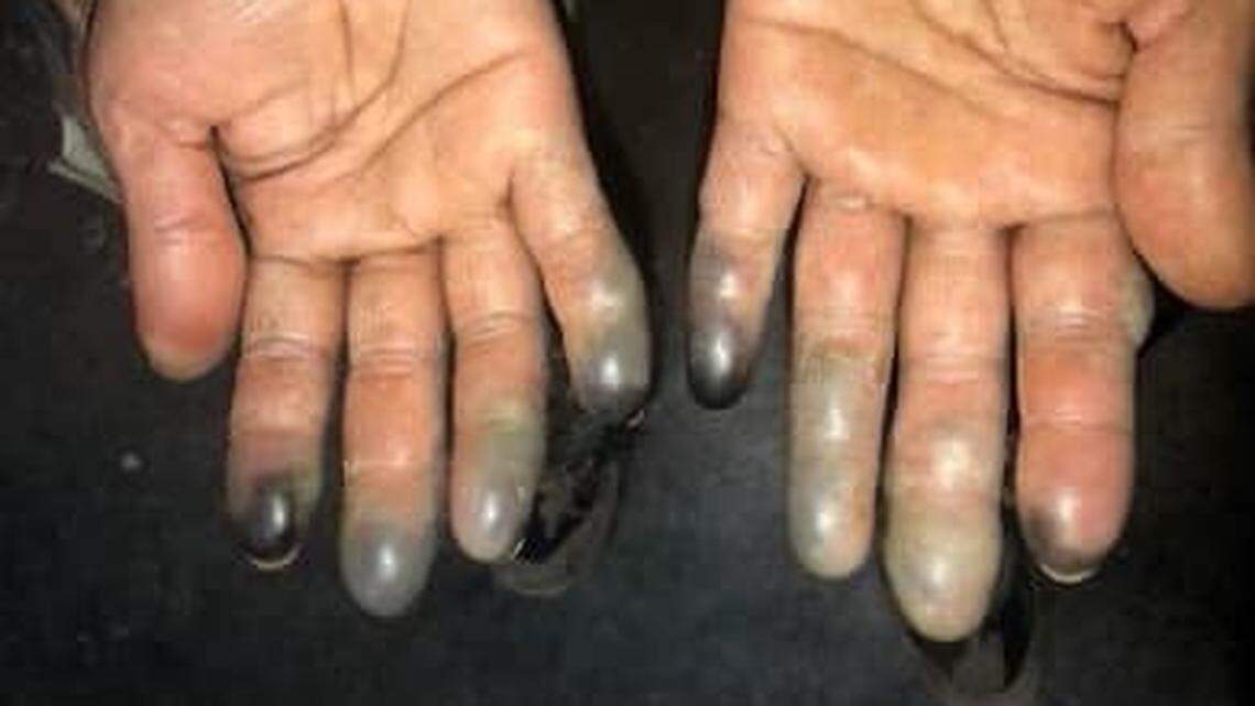 An immigrant woman survived for six days in the Texas winter storm before patrol agents rescued her at a ranch, according to U.S. Customs and Border Protection. She suffered from severe frostbite. Photo from US Border Patrol Big Bend Sector on Facebook.