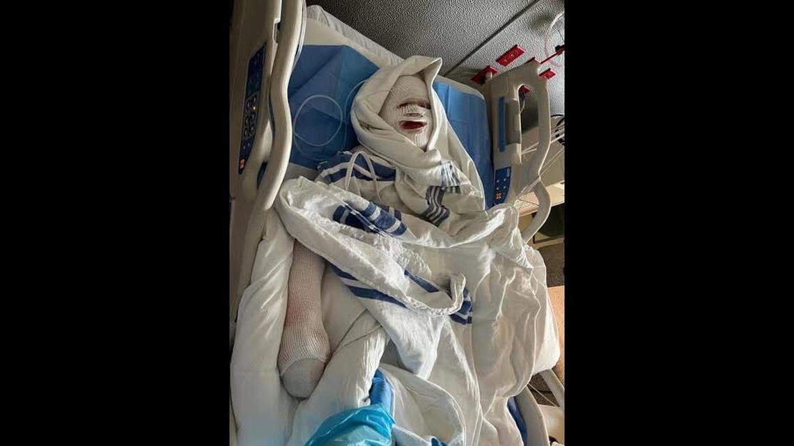 Barrett McKim, 12, suffered severe burns on over half his body after a science experiment he was working on exploded, his father said.