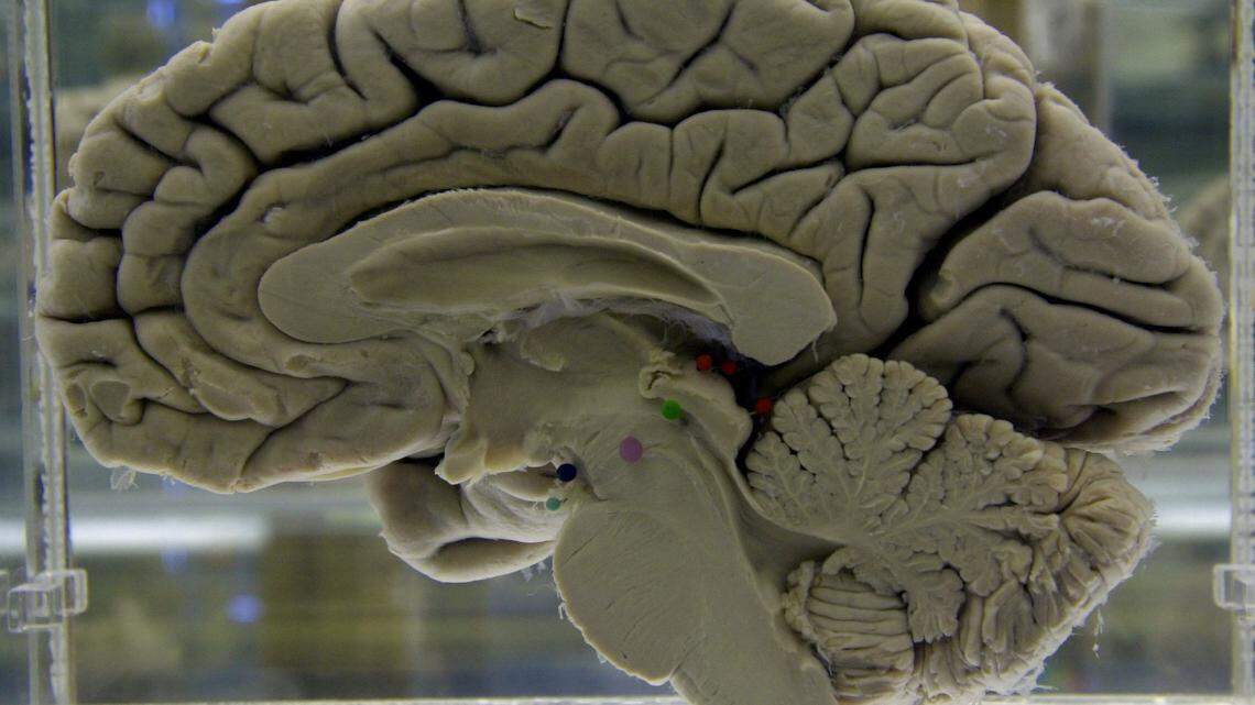 Catching COVID might cause brain shrinkage in some people, new study finds. Here’s how