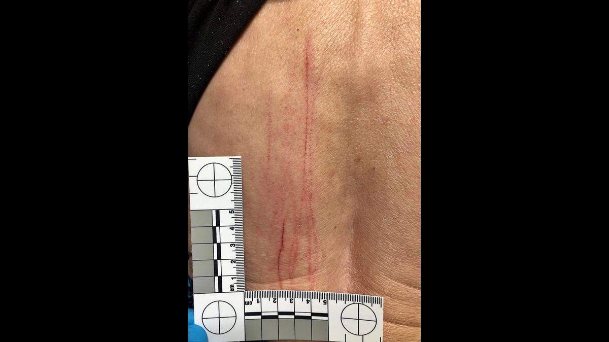 The victim of a deer attack displays some of the scratches, cuts and bruises she suffered on her back after the deer reared up on its hind legs and thrashed her with its hooves. The deer followed the victim into her home and attacked when the woman tried to make it leave. Colorado Parks and Wildlife believes neighbors were illegally feeding the deer and an investigation is underway.