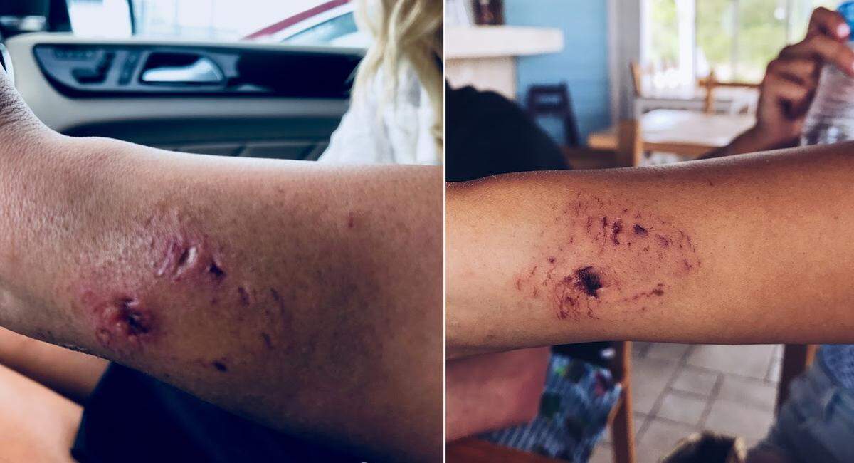 Katarina Zarutskie's doctors tell her she still has a small piece of the shark's tooth inside her arm.