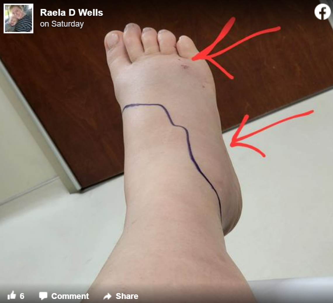 A copperhead bit Raela Wells twice while she was walking her dogs last week, she says.