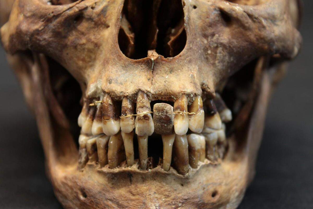 D’Alègre had gold wiring twisted around and between her teeth to hold them in place after developing periodontal disease.