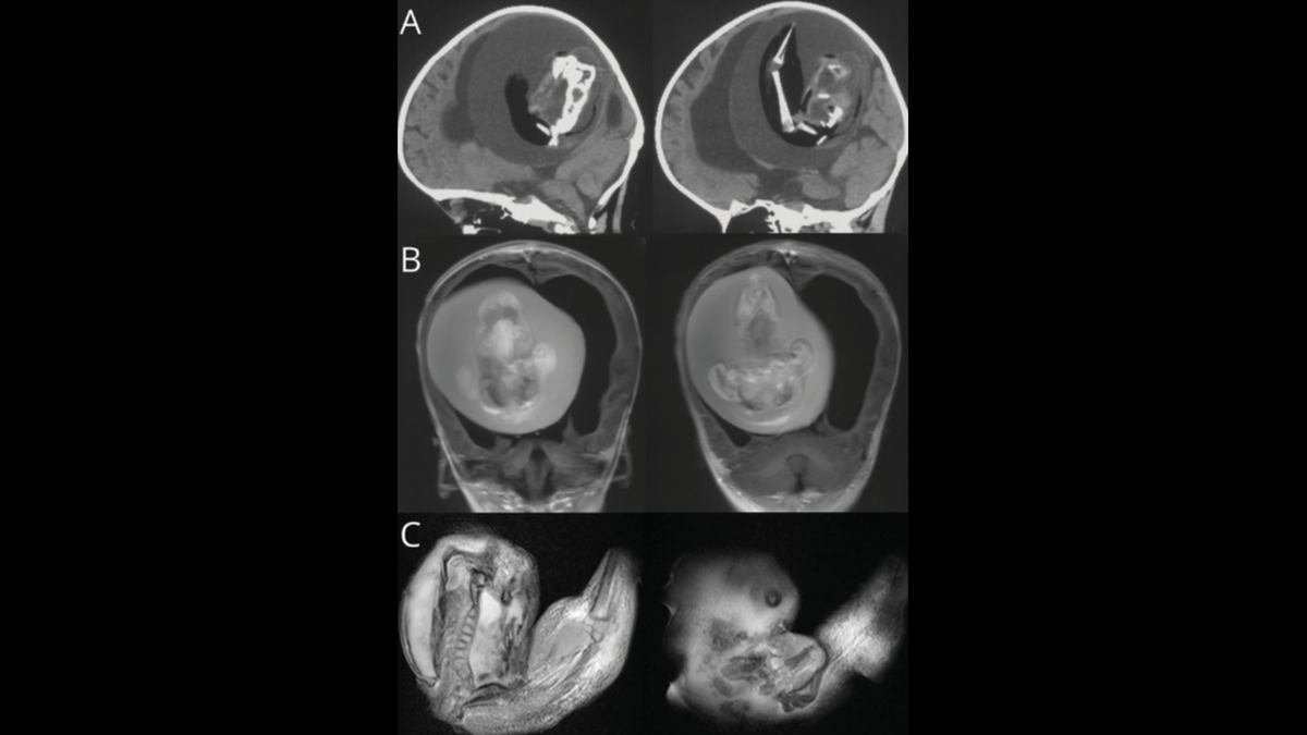 The parasitic twin was around 10 centimeters long and had arm and hand structures, the doctors said.