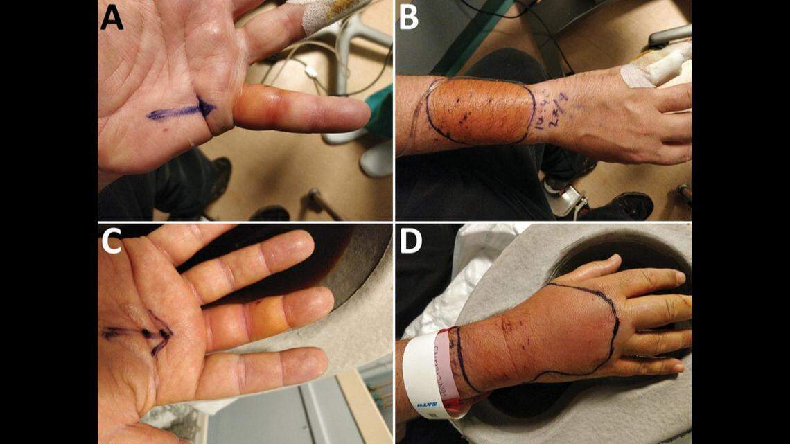The infection made it hard for the man to move his fingers and his skin was painful to touch, doctors said.