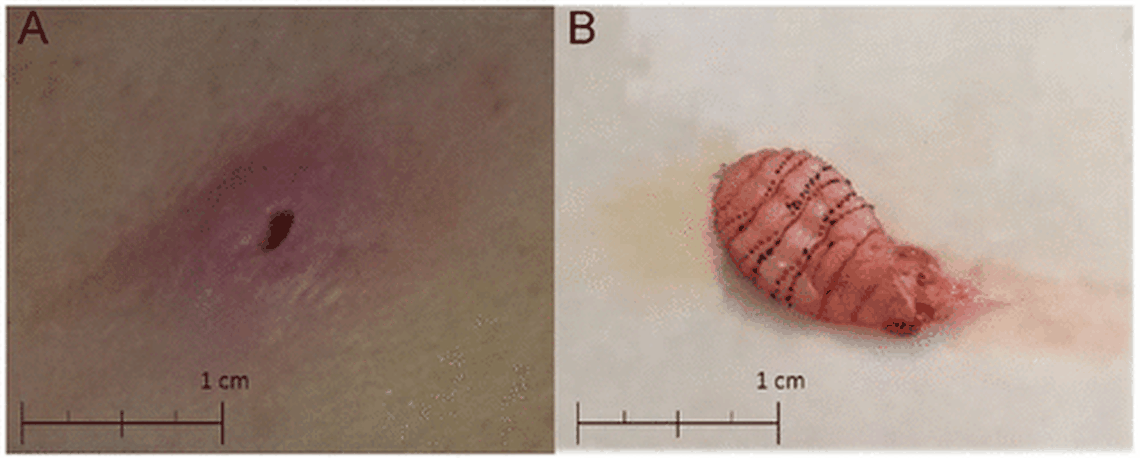 A Tampa, Florida, hospital found a human botfly maggot under a woman’s skin months after she took a vacation in Belize, a case report in the Journal of Investigative Medicine said. The botfly is rare in the US but common in the tropics and easily treated.