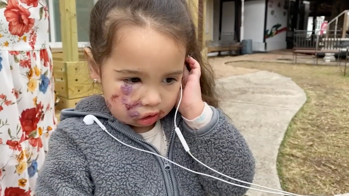 Ronin Waldroup, 3, was attacked by a dog at a restaurant in Spring, Texas, authorities say. Screengrab from KTRK.