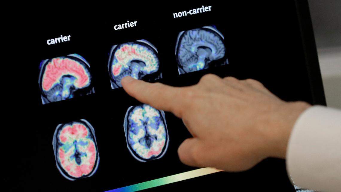 Dr. William Burke goes over a PET brain scan on Aug. 14, 2018, at Banner Alzheimer’s Institute in Phoenix.