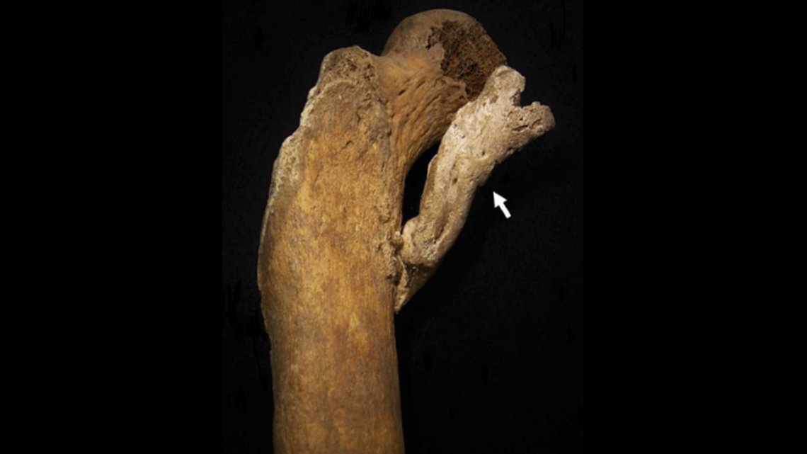 The 3-inch “rope-like” bone growth would have been extremely painful, researchers said.