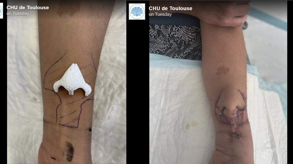 Doctors grew a nose on a French woman’s arm and then transplanted it onto her face.