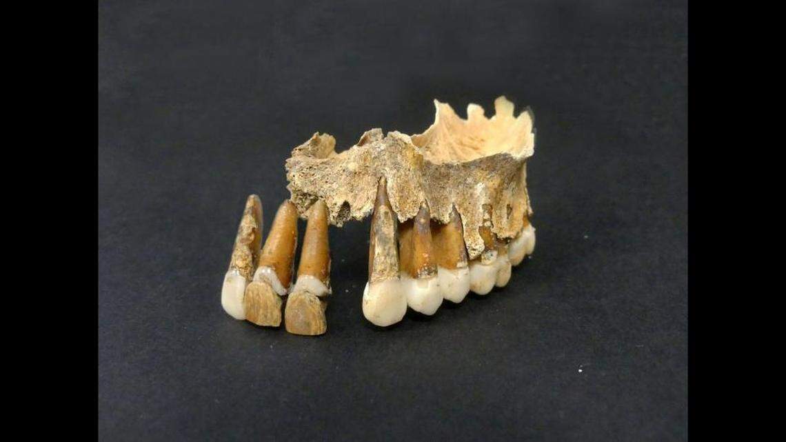 The dentures were made of a metal post attached to a tooth made of a bone-like material.