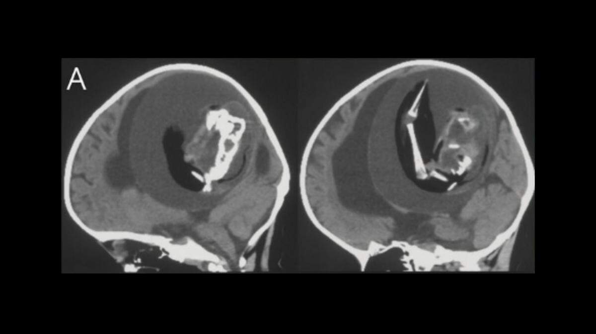 Inside the 1-year-old’s brain, doctors could see a spine and other bone structures.