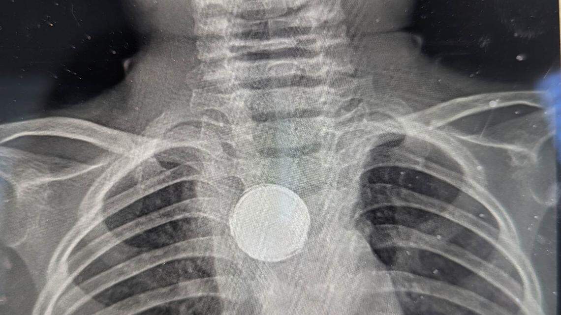 The surgeons asked the toddler’s parents if he had swallowed a button or coin, because there was “no way it was a battery” after being inside him for five weeks.