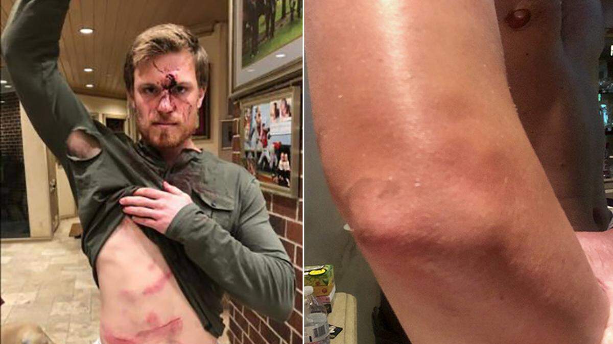 Minor-league baseball player Connor Capel, left, displays injuries he says came from bouncers at Houston bar Concrete Cowboy. At right is a photo of Kacy Clemens’ elbow after the incident, according to the lawsuit.