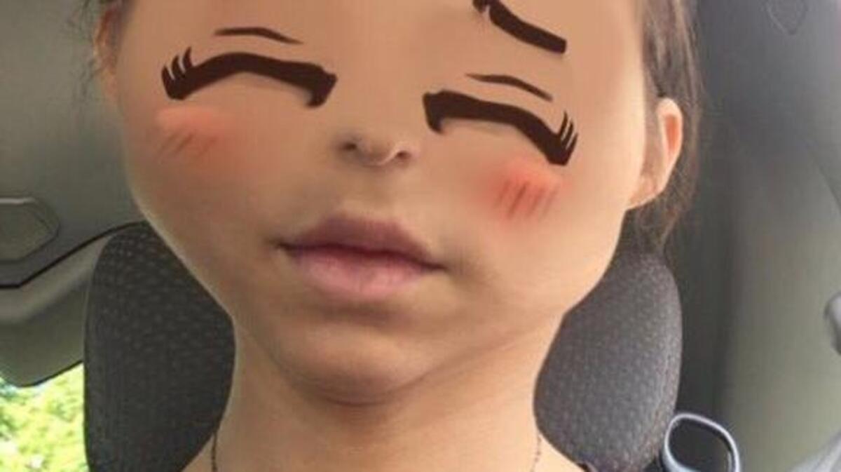 The controversial Snapchat filter gave users squinty eyes, and some said it even gave buck teeth.