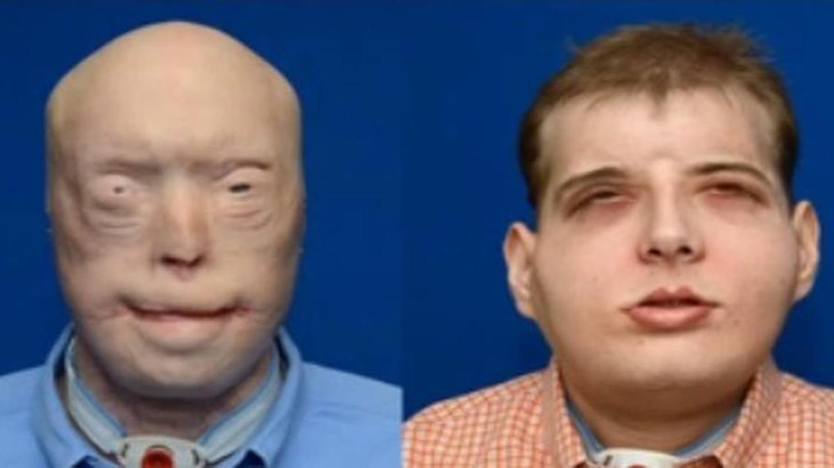 Patrick Hardison, 42, received the world’s most extensive face transplant.