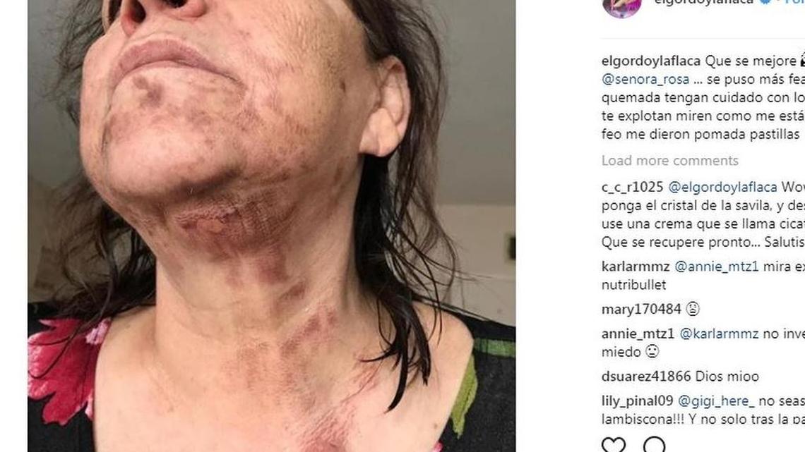 Rosa Rivera shows her burns she says that were caused from her Magic Bullet.