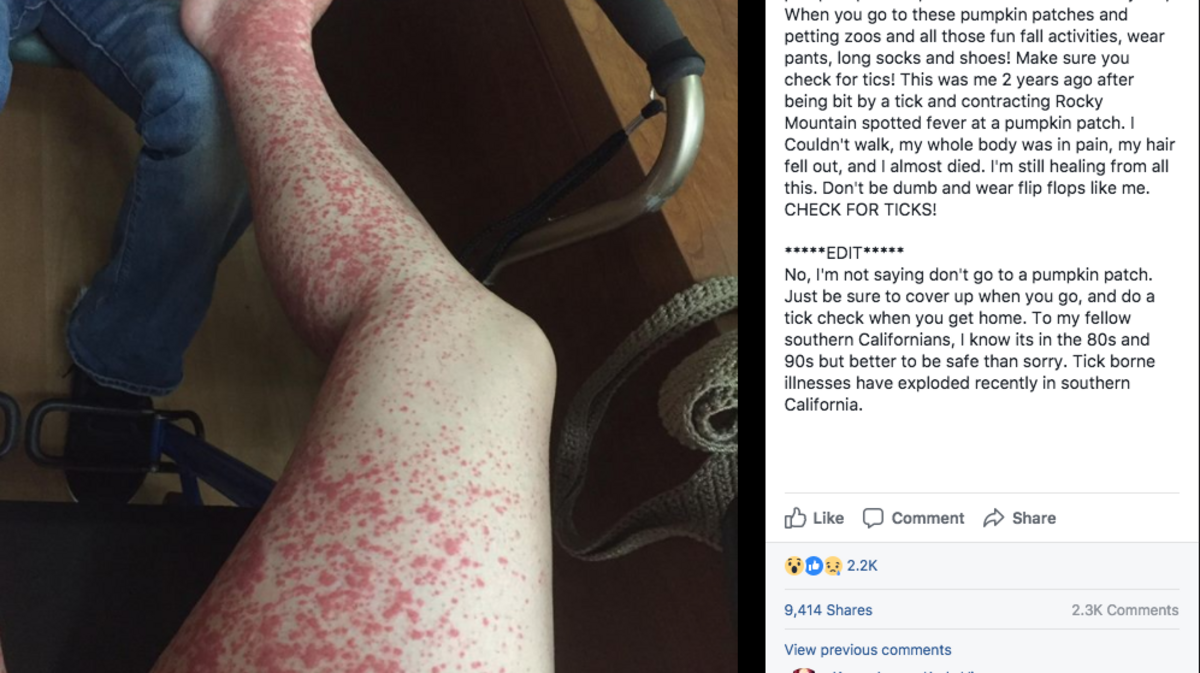 A California woman posted a warning on Facebook last week about avoiding Rocky Mountain Spotted Fever, a tick-borne illness that causes fevers, red bumps, nausea and headaches.