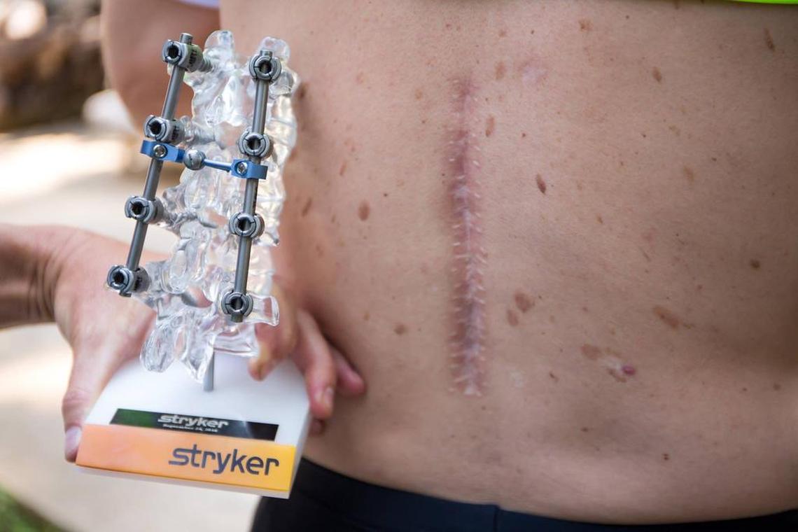 Dean Otto shows off his surgical scar, alongside a model showing the manner in which titanium rods and screws are holding his spine in place.