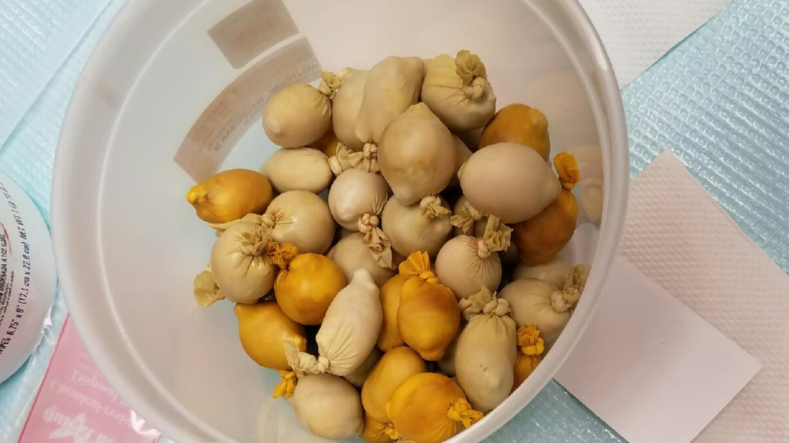Cocaine-filled rubber pellets removed from the belly of a man who collapsed at Miami International Airport.