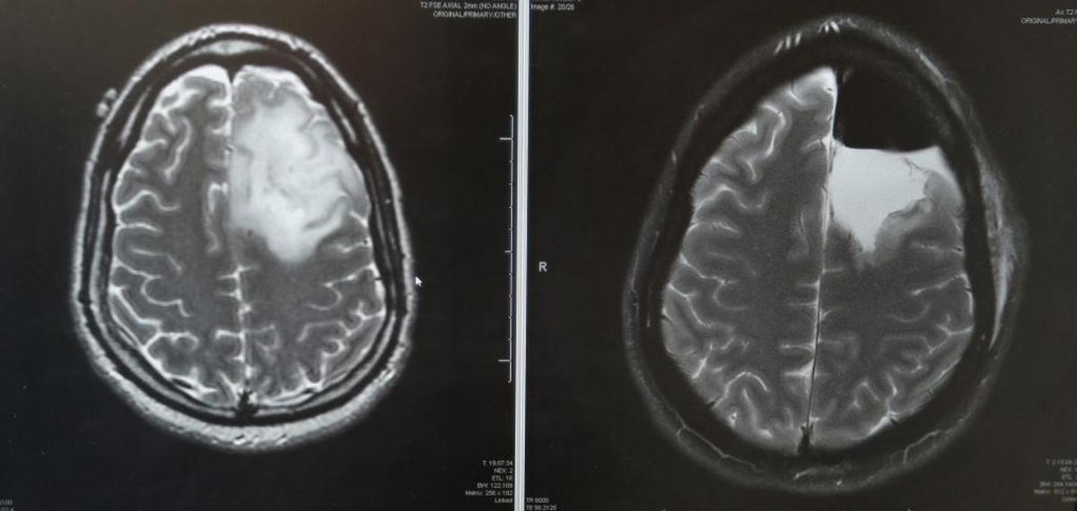 On the left, an MRI shows a fist-sized brain tumor inside of Taylor Hartsfield's brain. The image on the right of the screen shows the brain with the tumor removed following a special procedure, called an awake craniotomy, Ricardo J. Komotar, MD, FAANS, FACS, Director of Surgical Neurooncology at the University of Miami Hospital, performed the surgery on Hartsfield's brain tumor in late April, and Hartsfield sang and talked throughout the procedure. The blank space on the screen indicates where fluid filled in the part of the brain that was removed. On May 10, 2017, Hartsfield and his family visited Dr. Komotar for a follow-up appointment.