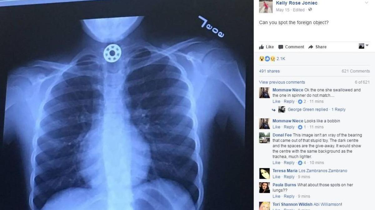 Houston area mom Kelly Rose Joniec posted this X-ray of a fidget spinner part lodged in her daughter’s throat.