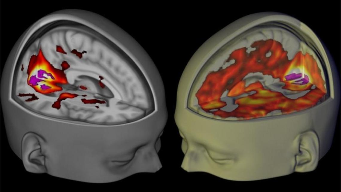 Under the influence of LSD, the brain's visual cortex has increased connectivity with other regions of the brain (right) than when under placebo (left).