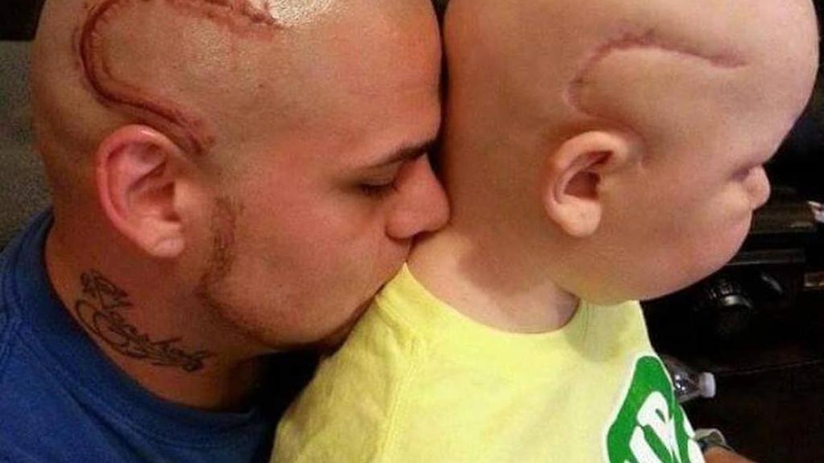 Josh Marshall and his son, Gabriel, pose for a picture to show off their matching scars in June.