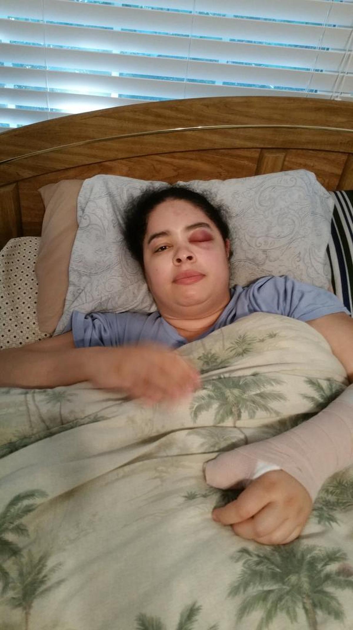 Besides suffering brain injuries, Rosie Anderson had additional problems from the attack: nerve damage in her back and broken bones in her hand.