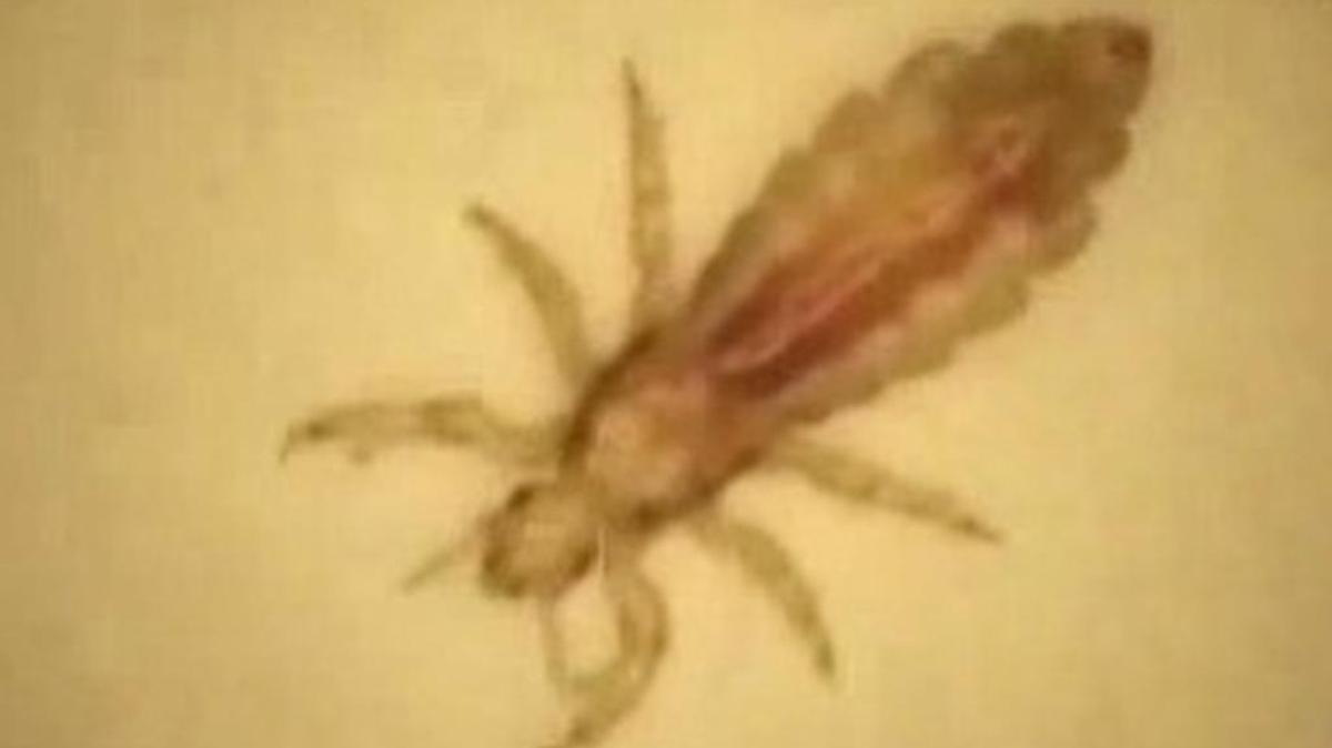 A doctor from Johns Hopkins points out that no serious infectious diseases have been shown to be spread by head lice. “It's just a social disaster and itchy.”