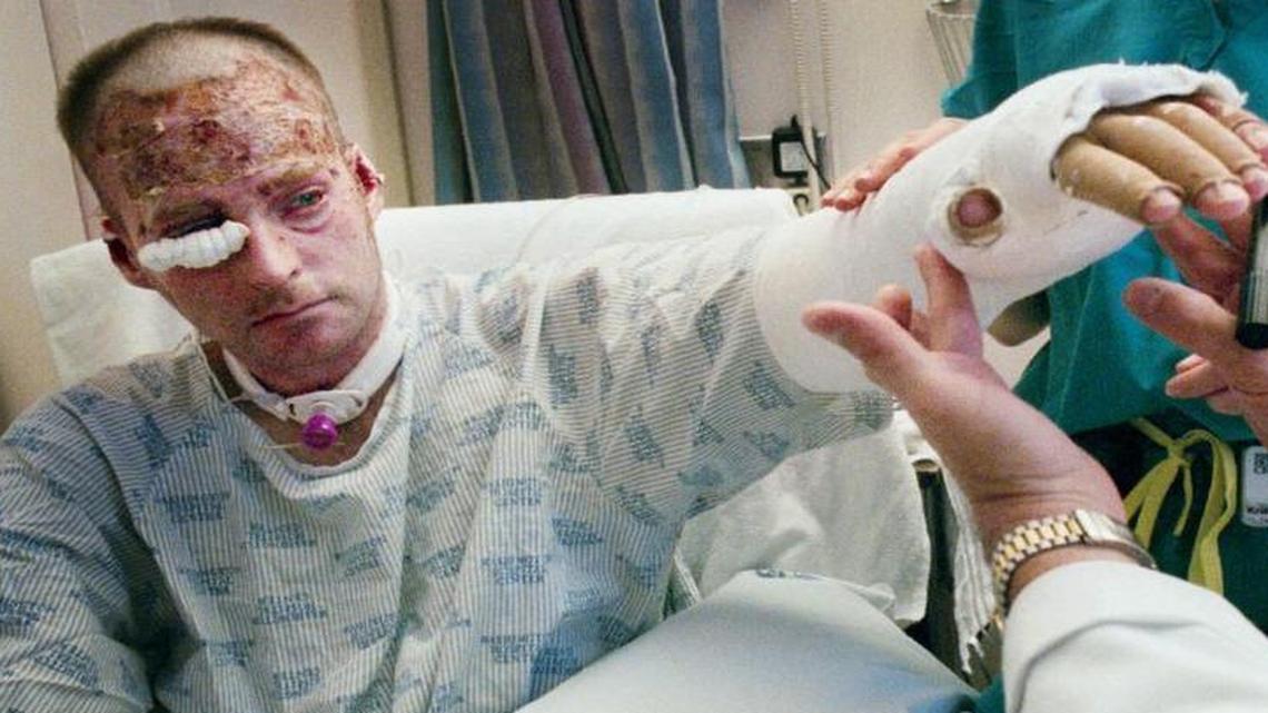 Lt. Col. Brian Birdwell shows his cast to Marion Jordan and physical therapist Kristen Dammen at Washington Hospital Center burn unit. Birdwell was badly burned while working at the Pentagon on Sept. 11, 2001.