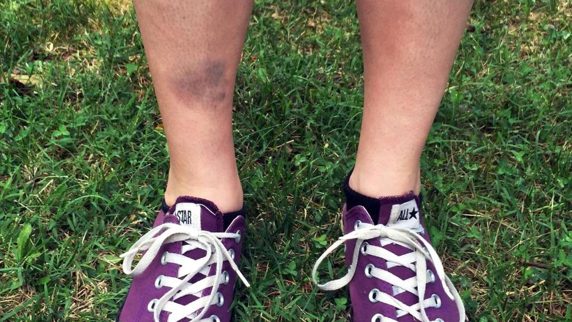 This July 8, 2016, photo provided by Justin Harrison shows the bruised shin of Lindsay Plunkett, a 23-year-old waitress in Asheville, N.C., after she tripped over a cinder block that had been used as a doorstop while playing Pokemon Go.