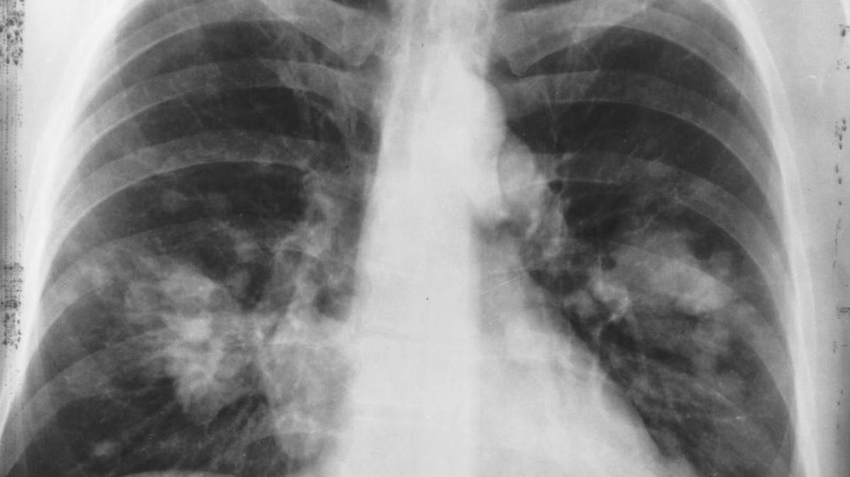 This is an x-ray image of a chest. Both sides of the lungs are visible with a growth on the left side of the lung, which could possibly be lung cancer.