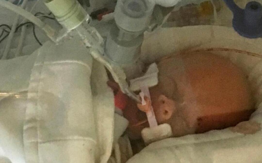 In this Sept. 8 photo provided by Sonya Nelson, Life Lynn DeKlyen lay in the Neonatal Intensive Care Unit of the University of Michigan Hospital in Ann Arbor, Mich.