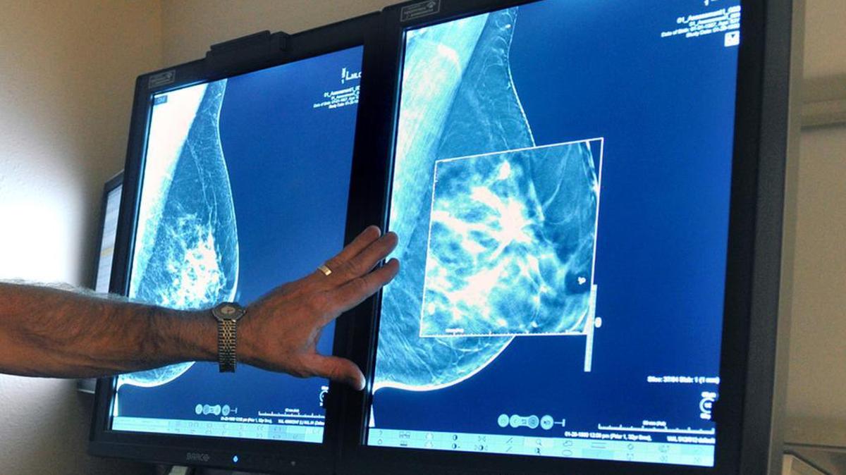 A radiologist compares an image from earlier, 2-D technology mammogram to the new 3-D Digital Breast Tomosynthesis mammography in Wichita Falls, Texas. The technology can detect much smaller cancers earlier. Some health groups urge mammograms every year starting at 40 – although last year the American Cancer Society upped its starting age to 45.