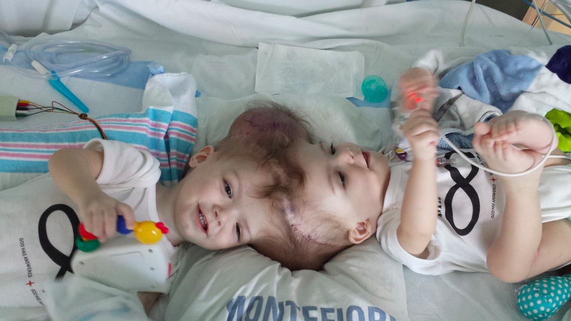 Anias and Jadon McDonald, both 13 month old, went under the knife to separate their conjoined heads Thursday. The surgery lasted more than 16 hours.
