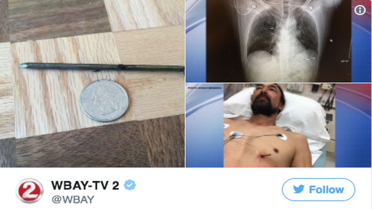 Doug Bergeson -- and the nail he shot himself with.