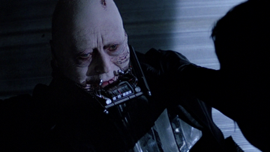 Darth Vader, when he is finally unmasked in the “Star Wars” franchise, is shown to suffer from multiple facial scars, alopecia and lack of pigmentation.