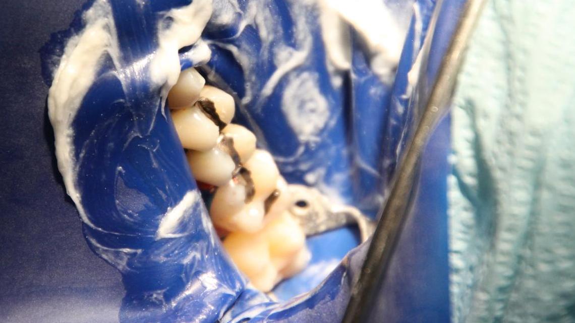 Mercury/silver filled teeth exposed through a rubber dam which in inserted into the patients mouth for protection from mercury gas and vapors which are emitted during the removal process. Note white sulfur cream on rubber dam which provides the patient further protection from mercury vapors.