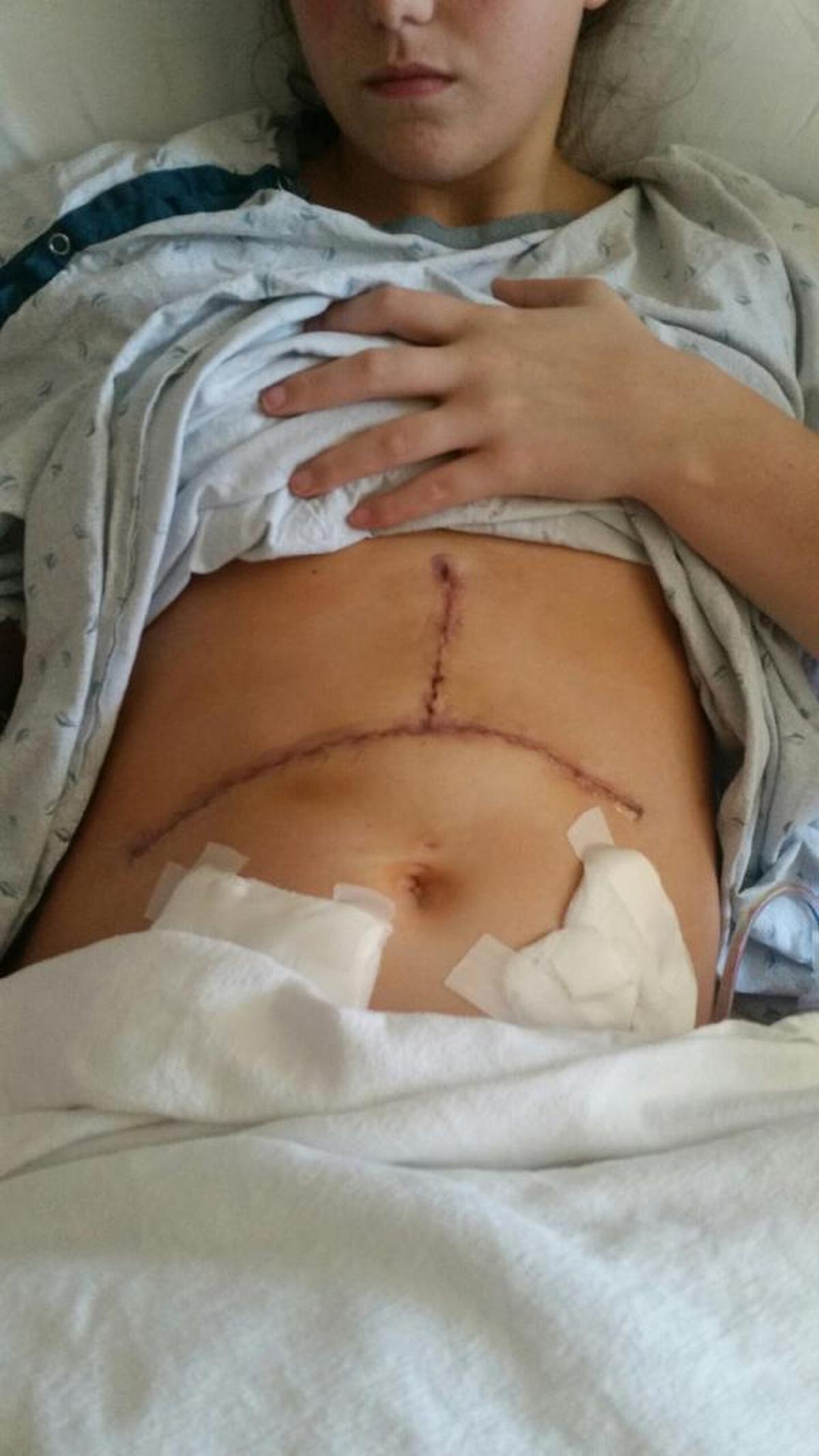 Hayley Illig’s liver transplant left her with a long scar on her stomach shaped like an upside-down “T.”