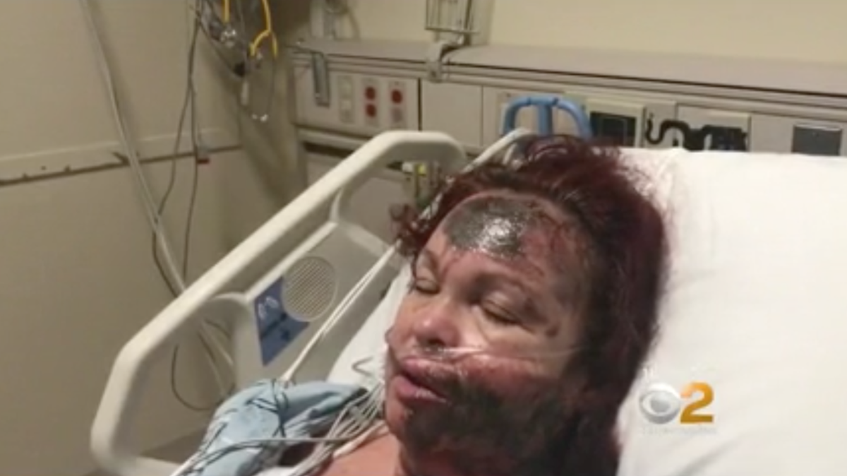 Police say Lizzie Dunn sprayed herself with acid and then said a stranger attacked her.