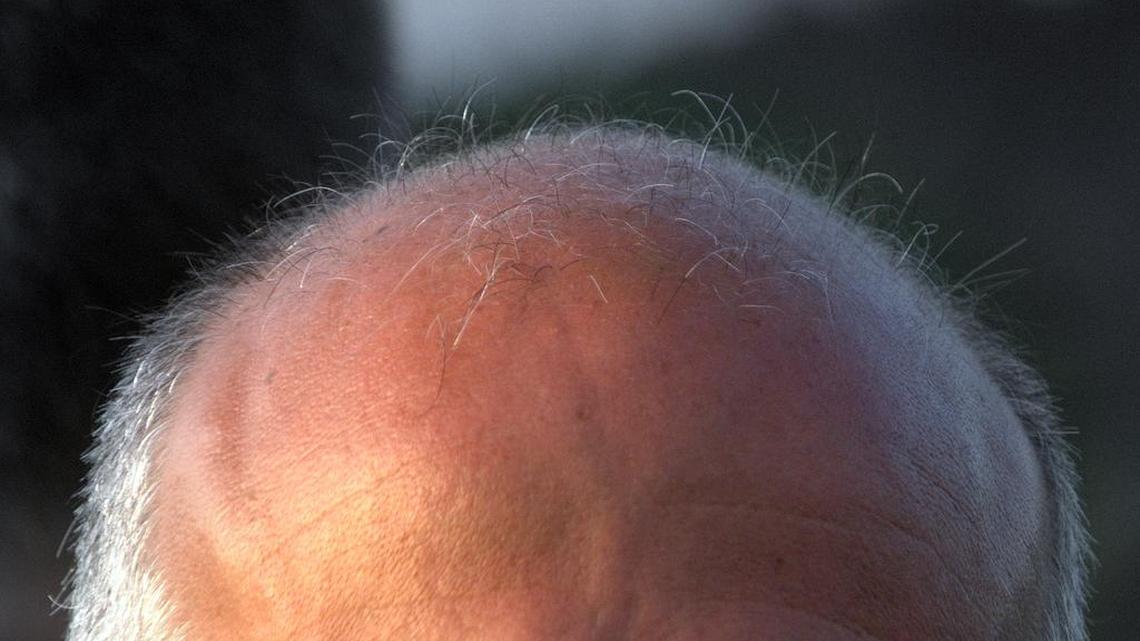 Scientists may have found a cure for gray hair and baldness by accident