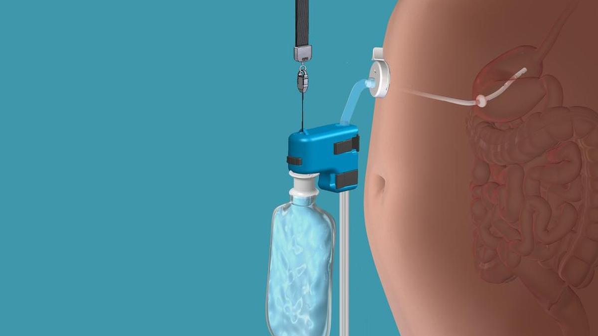 This rendering provided by Aspire Bariatrics, Inc. demonstrates the use of the AspireAssist weight loss device, approved by the Food and Drug Administration.
