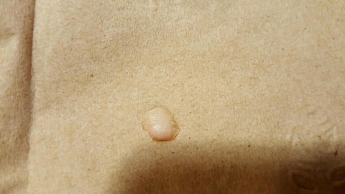 This is the fingertip that an Atascadero woman claims she found in her Chinese chicken salad at Applebee’s.
